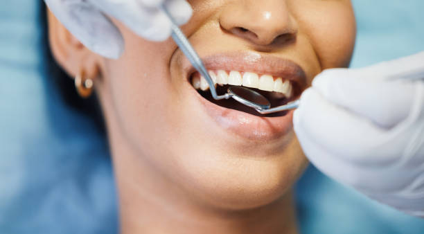Best Emergency Wisdom Tooth Extraction in Kensington, CA